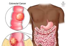 Colorectal Cancer Therapeutics Market Size Set to Cross USD 20.1 billion by 2028
