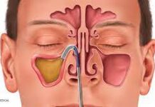 Single-Use Assemblies Market to Grow at a CAGR of 18.9% during Forecast Period Single-Use Assemblies Market