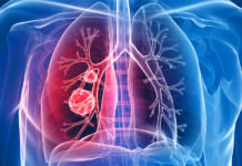 Lung Cancer Genomic Testing Medicine Market to Grow at a CAGR of 10.1%, 2022-2028 lung cancer genomic testing medicine market