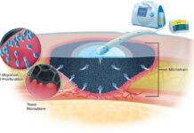 Negative Pressure Wound Therapy Market Size to Cross USD 4 Billion by 2028 Negative pressure wound therapy market