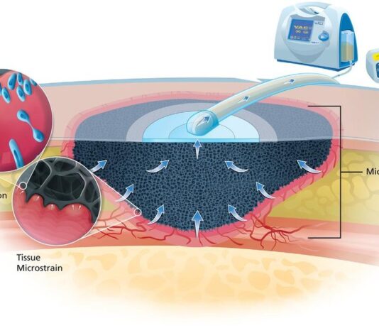 Negative Pressure Wound Therapy Market Size to Cross USD 4 Billion by 2028 Negative pressure wound therapy market