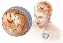 Deep Brain Stimulation Devices Market to Reach USD 2.0 Billion by 2028 Deep Brain Stimulation Devices Market
