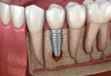 Global Peri-Implantitis Treatment Market to Expand at Steady CAGR of 8.1% During 2023–2029 Peri-Implantitis Treatment Market