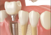 India Dental Bone Graft Substitute Market Size to Grow at Impressive CAGR of 8.3% During 2023–2029 India Dental Bone Graft Substitute Market
